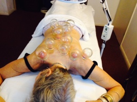 Cupping and acupuncture overkill!